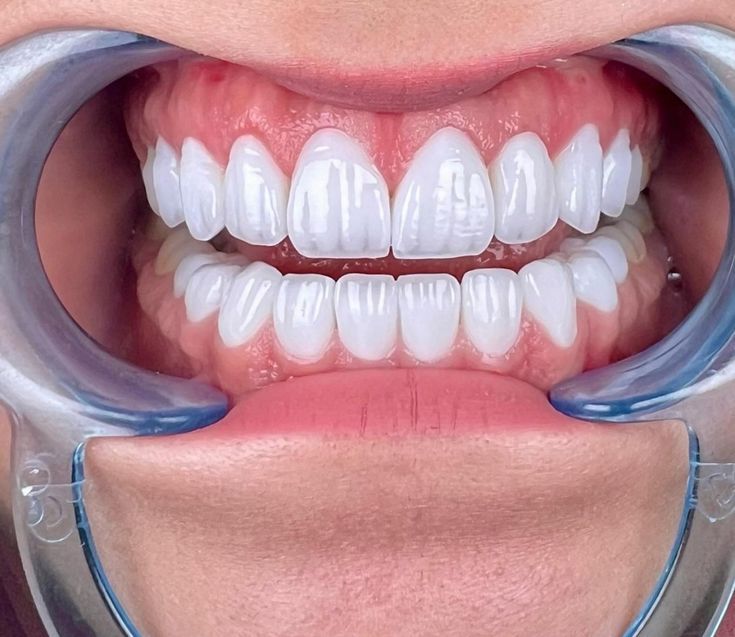 Răng sứ có bị mòn không? Nguyên nhân và cách khắc phục